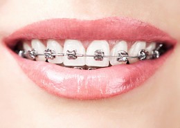 ortodoncja, aparat ortodontyczny