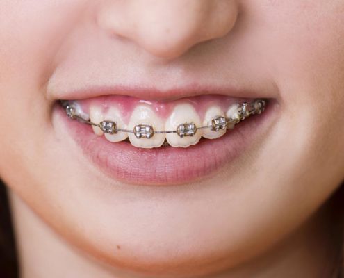 Prostowanie zębów i aparat ortodontyczny - Klinika Maria Kowalczyk